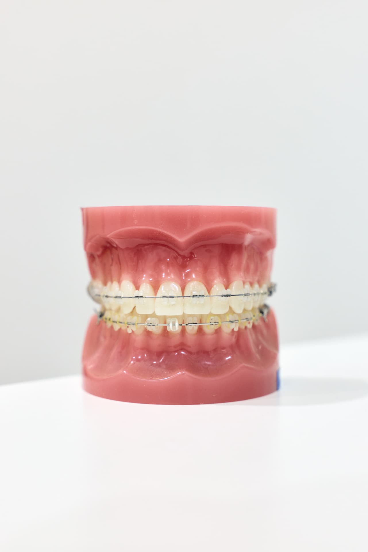 A dental model fitted with fixed braces and archwires
