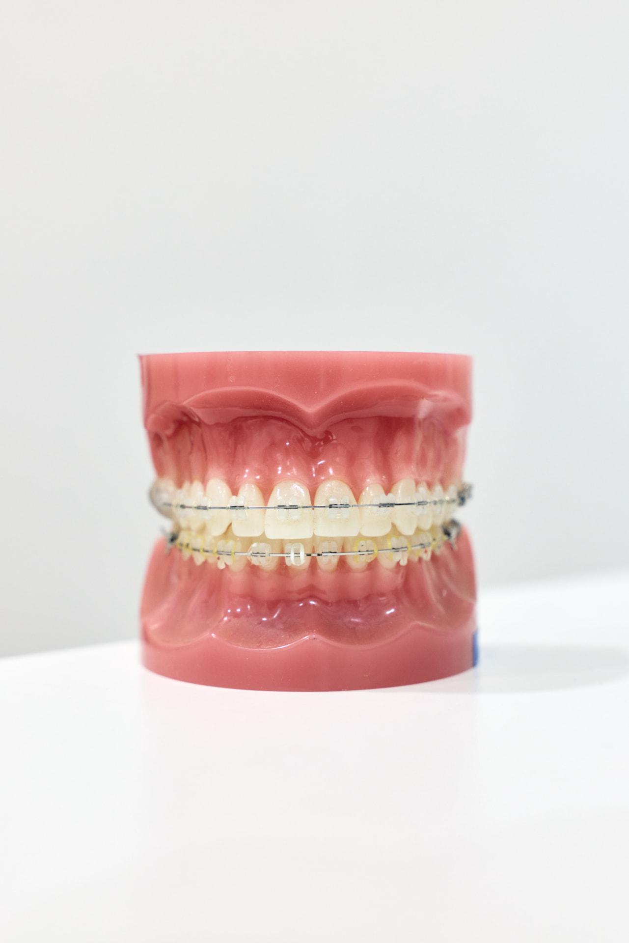 Patient wearing braces during orthodontic treatment